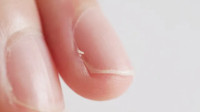 “ささくれ”悪化、炎症や「赤い線」が現れたら要注意、リンパ管炎になることも