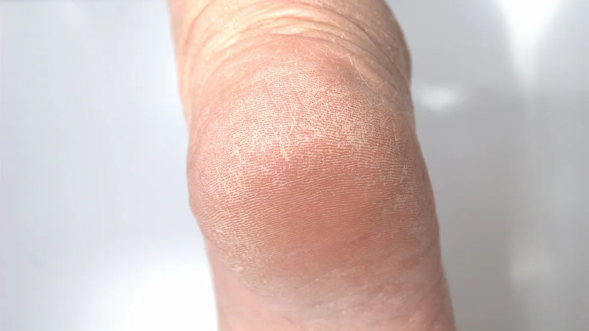 触った瞬間ゾッとする…「岩化かかと」になる前にやるべき冬の角質・保湿対策