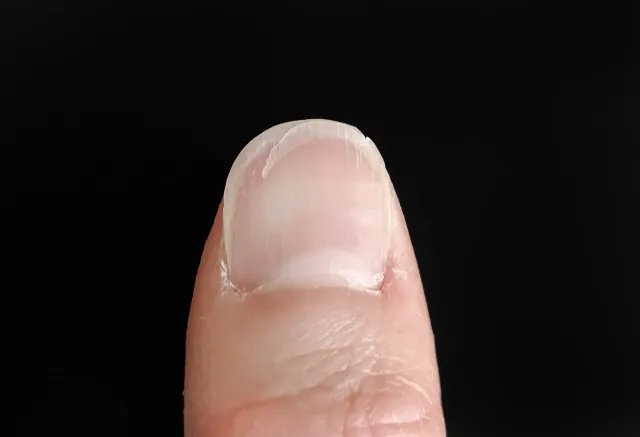 「爪の亀裂は放置しない」気分が落ちるだけじゃない…“爪の補修材”で爪トラブルも防ぐ