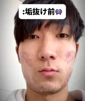 マスクで激荒れ…6年におよぶニキビ治療を諦めなかった男性「努力の賜物」「めちゃくちゃ垢抜けてますね！」