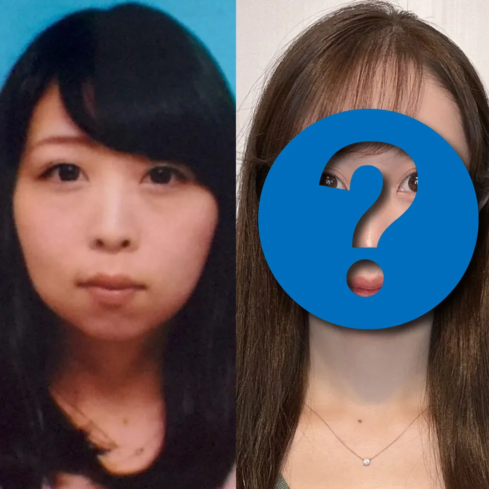 【整形美女】“お金で手に入れた見た目”はズルい?…1300万課金した女性が語る美の価値観「包帯を取っても美しい自分はいなかった」