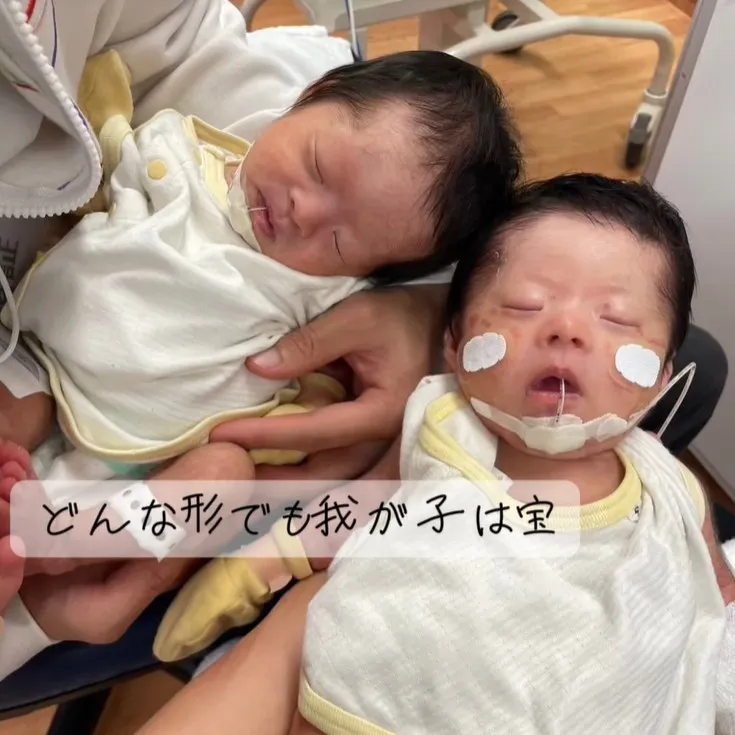 出産後に発覚、双子が2人ともダウン症…前を向く覚悟を決めた夫婦の想い「全力で応援して、愛情を注いでいきたい」
