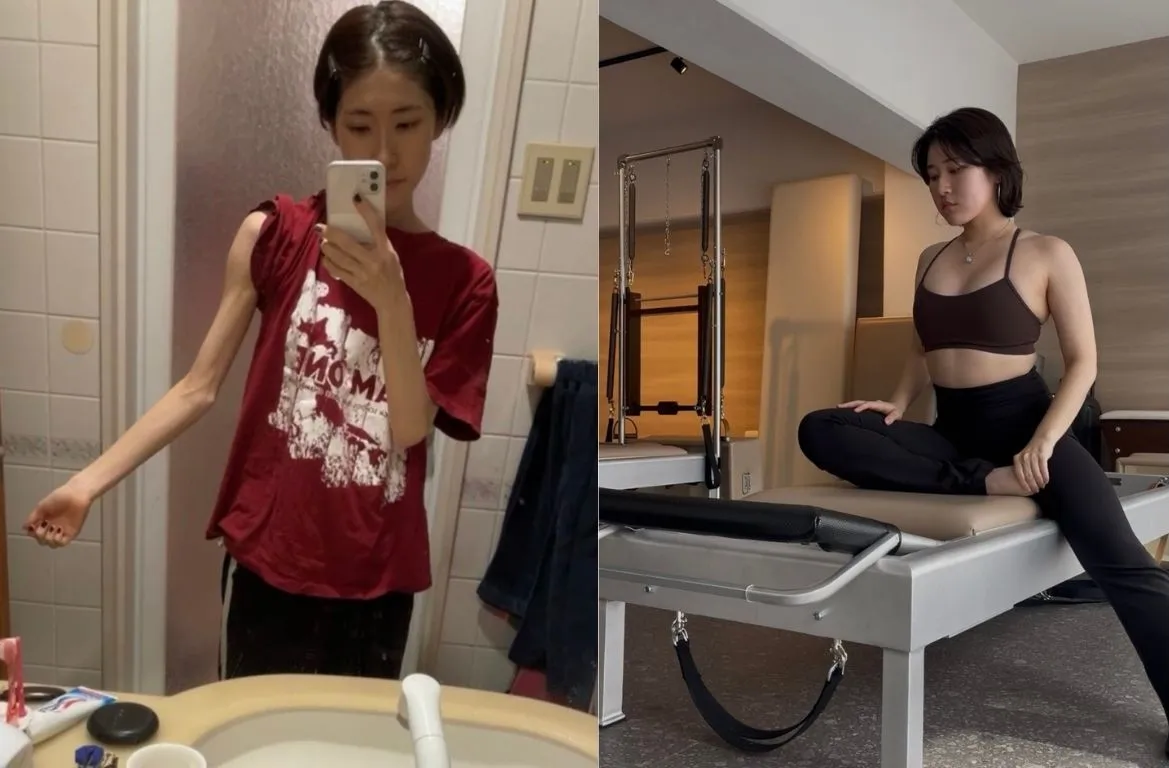 33kgから57kgへ…拒食症を乗り越えた女性、ビフォーアフター公開の理由　「ダイエットのデメリットが伝わらない」問題意識も