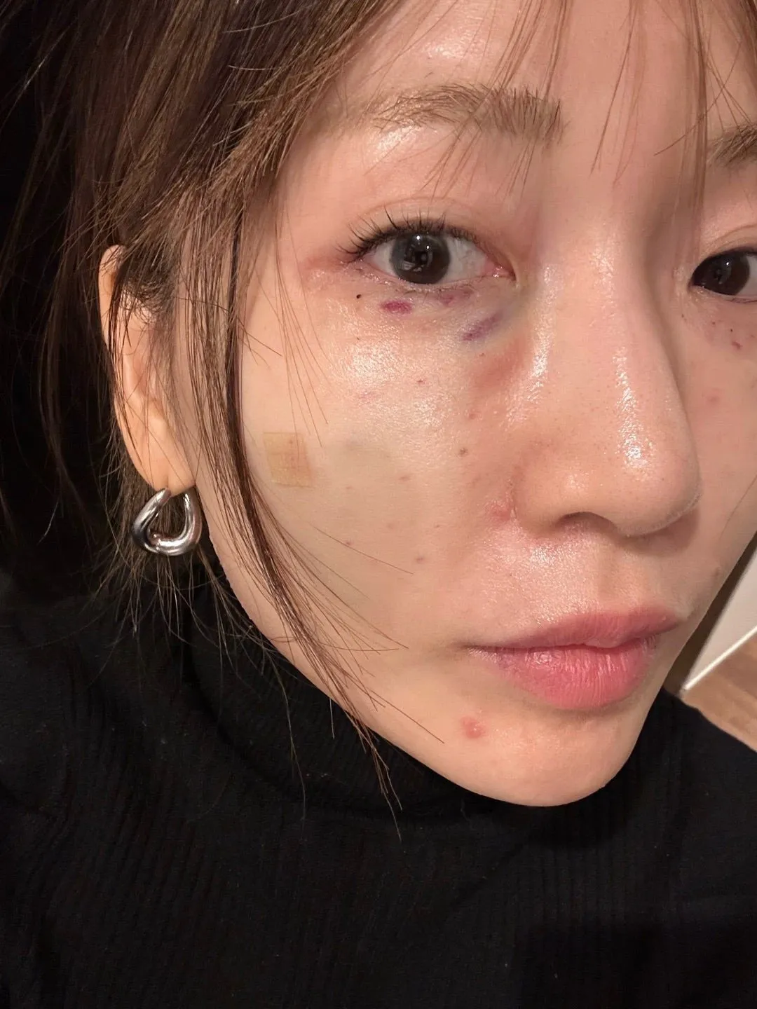 『あいのり』桃、自身の「ダウンタイム」ショットを赤裸々公開　美容整形や脂肪吸引の写真も紹介