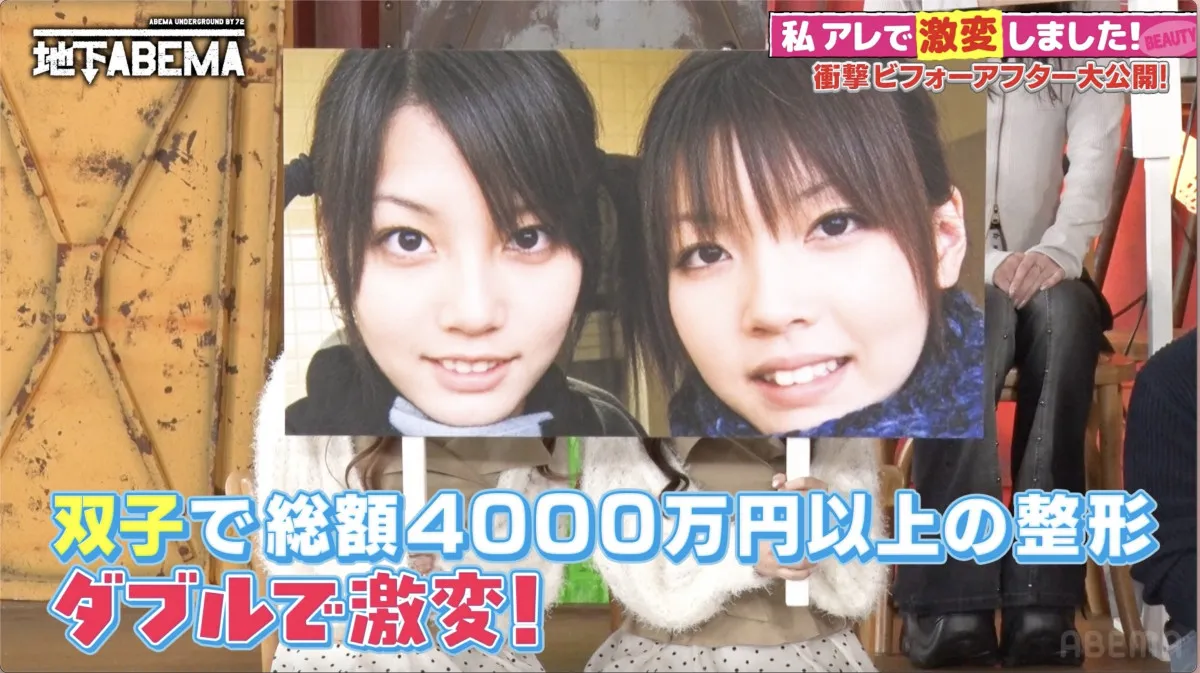 双子で整形、総額4000万円　顔へのコンプレックスは中学時代“周囲から比較”「姉の方が可愛い」