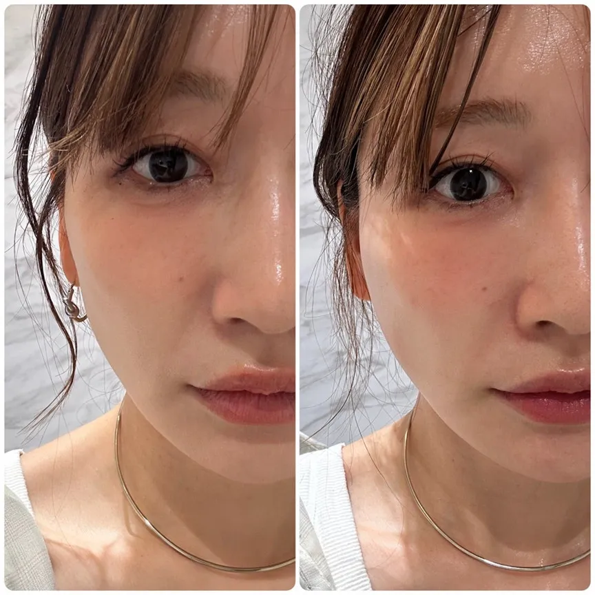 41歳・あいのり桃、糸リフト施術後の変化　投稿に「before→afterの違いが凄い!!」「すごい！シュッとしている！」