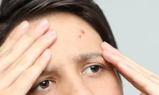 ニキビの“巻き込み剃り”経験率は半数以上！おすすめケア方法は？