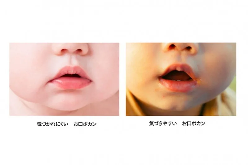 「お口ポカン」防止トレーニングで、子どものお口の悩みに貢献。