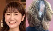 【 がん闘病 】古村比呂さん「頭皮の帯状疱疹になって 髪の毛が部分的にごっそりと抜けてから 約1年」「見事に生えてきました」