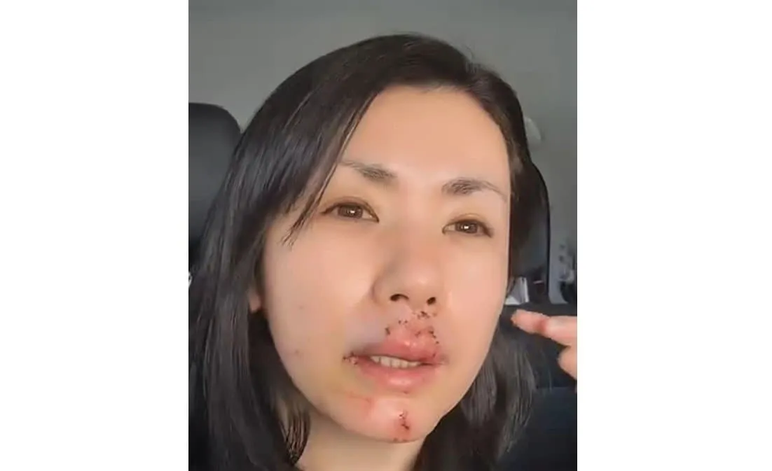 【 小島可奈子 】　顔面を犬に「噛まれました」　４針ほど縫うケガ　痛々しい傷跡の動画公開　