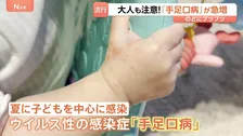 大人も注意「手足口病」急増！のどにプツプツ「痛くて食べられない飲めない」 子育て現場では手洗い徹底＆個別タオル　大人も子どもも引き続き注意が必要