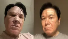 先月、転倒し大けが・鼻を骨折　【 三ツ矢雄二 】 「だんだん回復して来ました。まだ、頭はジンジン痛いけど。おでこの左側にでっかい傷跡が残ってます」　現況を報告