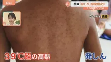極めて感染力が強い「はしか」関東で報告相次ぐ　感染すると免疫がリセットされることも【Nスタ解説】　