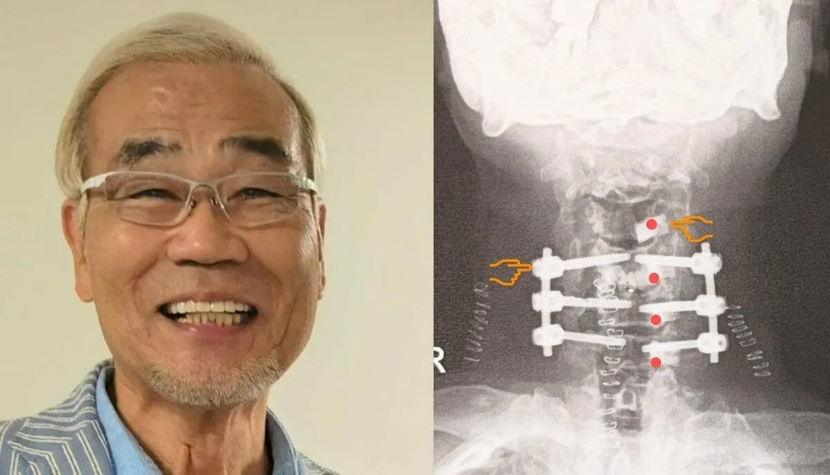 【 オール巨人 】 「今　首には11個の人工物が」　６回目の頸椎手術から半年　「術後.本当に二度と漫才は出来ない　人生が終わった思ってました」「こんなしんどい辛い半年に成るとは」