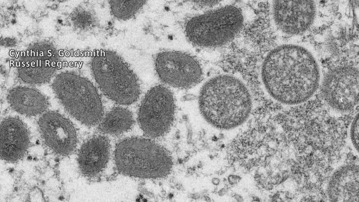 【速報】エムポックス重症型が日本国内で初確認　アフリカに渡航歴ある20代女性　厚生労働省