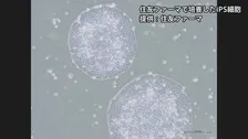 【速報】iPS細胞使ったパーキンソン病患者の再生医療製品「アムシェプリ」 公的医療保険の適用を了承 価格は約5530万円 中医協