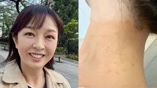 【 丸岡いずみ 】　人生初の毛虫被害で皮膚炎に　「こんなに痒いのね」　GWのキャンプや露天風呂が原因か