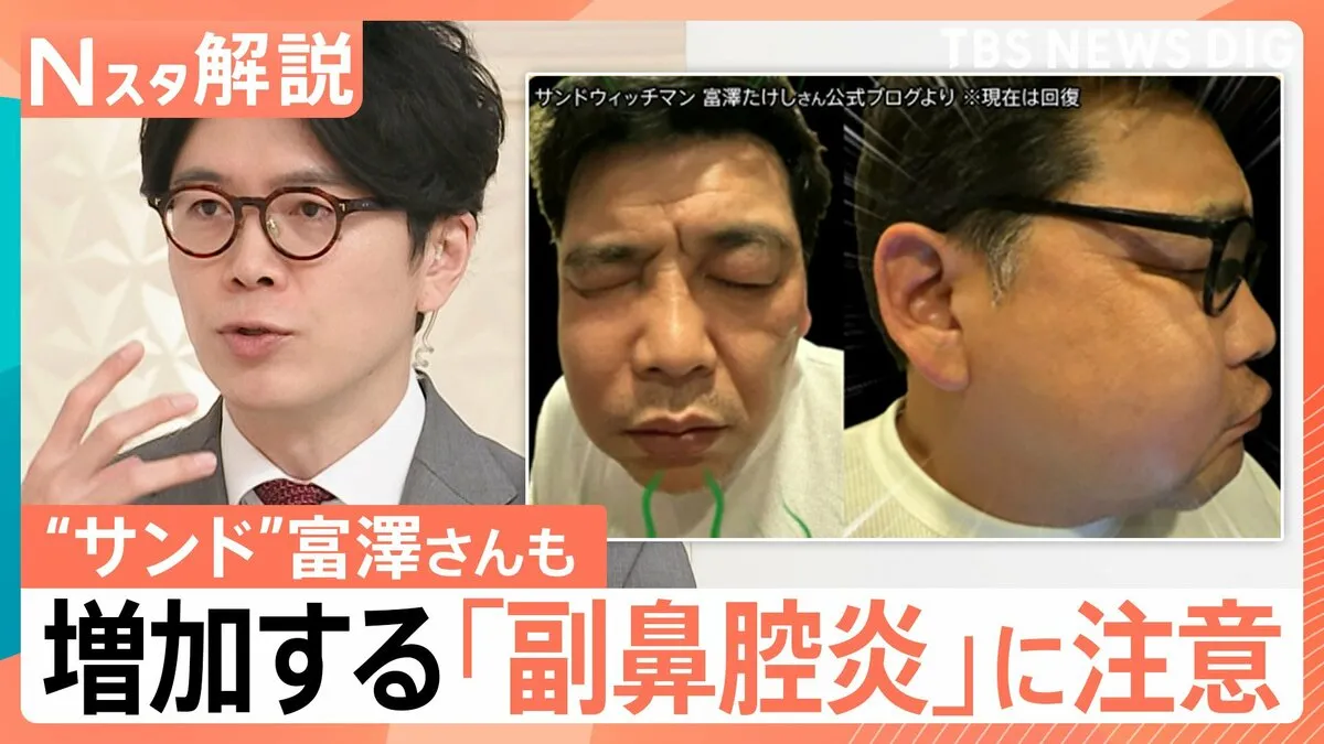 “顔の腫れ”に“視力低下”のおそれも…増加する「副鼻腔炎」　花粉のピークが過ぎた季節に注意したい“鼻トラブル”【Nスタ解説】