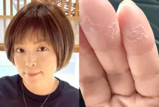 【 がん闘病 】石原詢子　抗がん剤の副作用を吐露「ここのところ、足の浮腫が尋常じゃなく・・」「手足の指の痺れ、、そして手の指の皮がめくれてきて痛い」