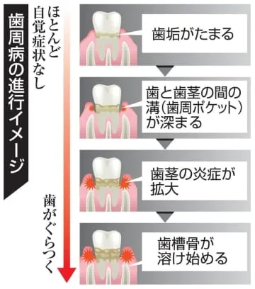 歯周病、簡易検査普及へ開発支援