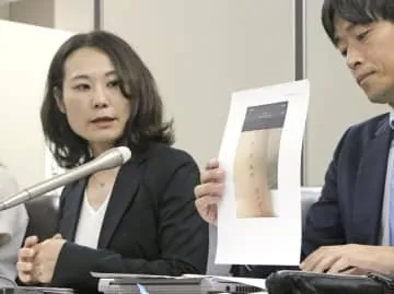 美容医療「ハイフ」で熱傷、提訴