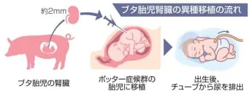 ブタ腎臓の重症胎児への移植申請